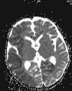 <b>Figure 1:</b> MRI brain showing hypointensity along the right middle cerebral artery territory and left occipital lobe.